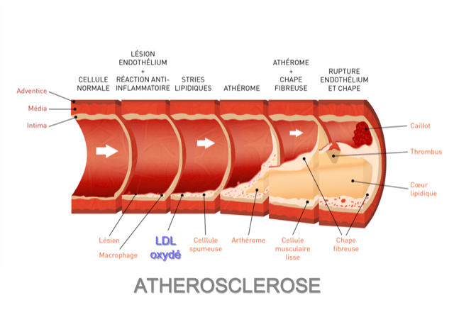 Atherosclerose